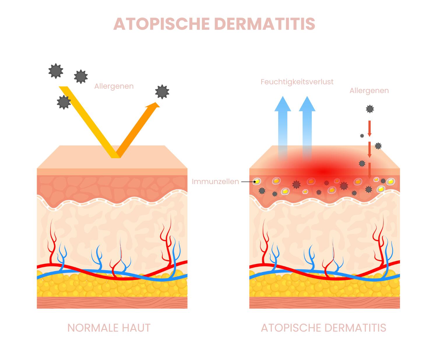 Eine Infografik zeigt links gesunde Haut mit intakter Barriere, rechts Haut mit atopischem Ekzem mit Rissen, Feuchtigkeitsverlust und entzündetem Bereich.